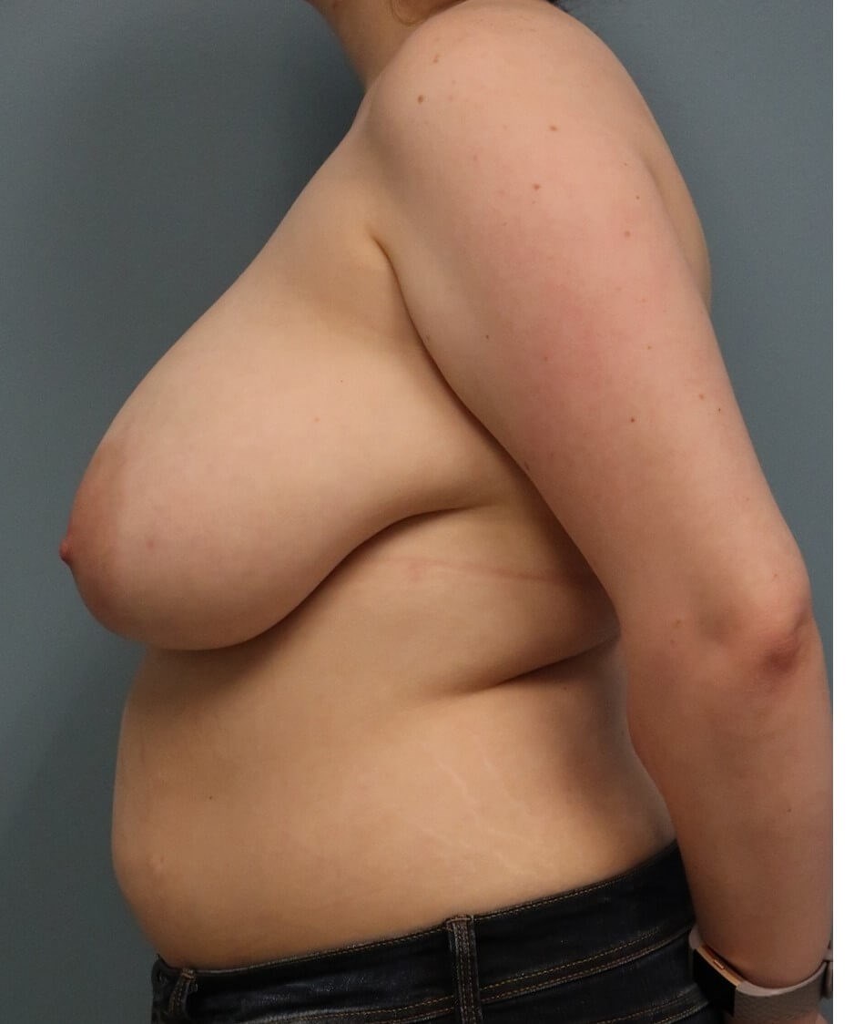 Breast Reduction Before Side View