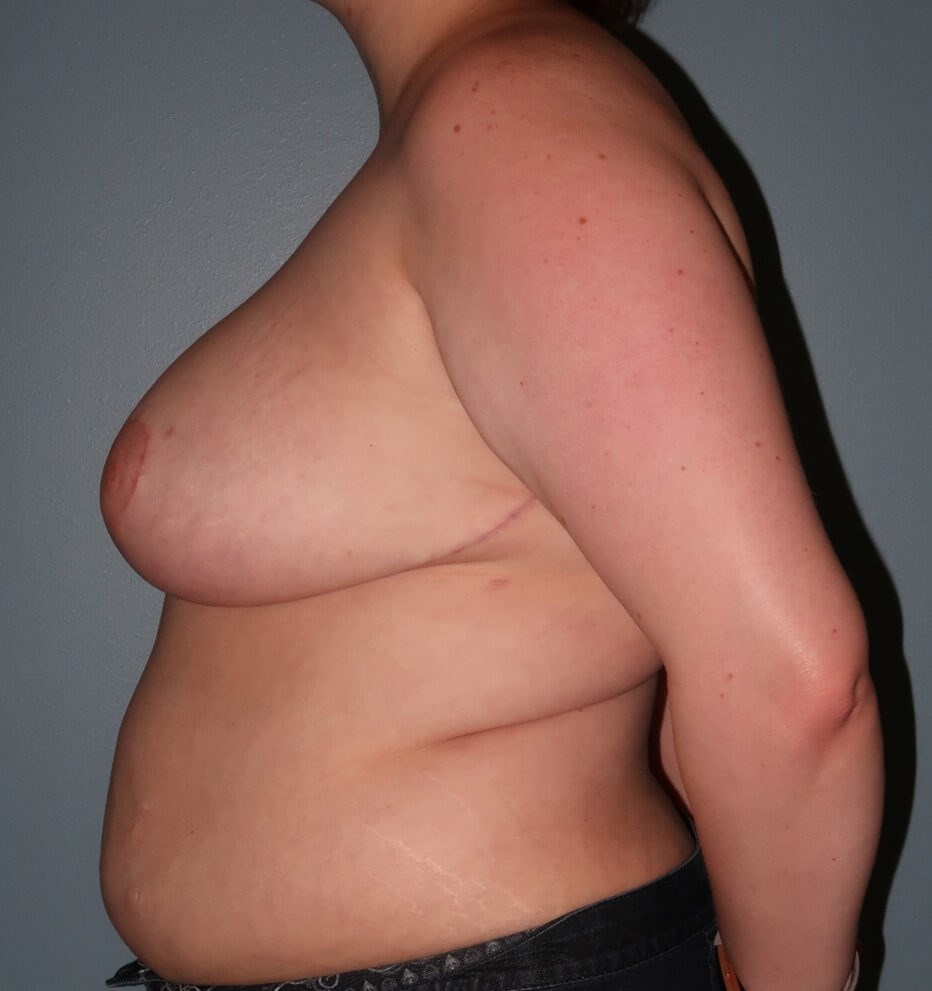 Breast Reduction After Side View