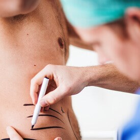 Liposuction
