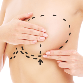 Lumpectomy Reconstruction