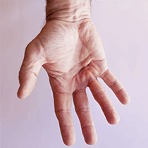 Dupuytren's Contracture